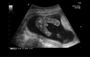 Видно ли пол на 16 неделе беременности