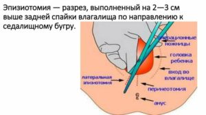 Почему после эпизиотомии нельзя сидеть