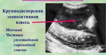 Взвеси в околоплодных водах на 39 неделе беременности