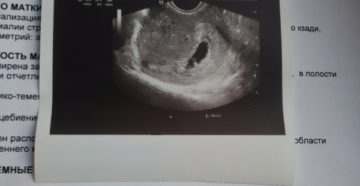 Беременность 4 недели фото эмбриона на узи