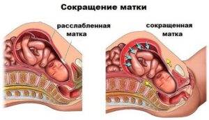 Матка во время беременности сокращается матка