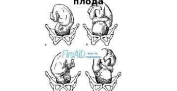 Положение плода продольное головное позиция 2 вид передний