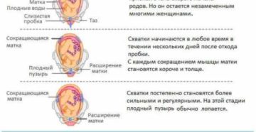 Могут ли быть ложные схватки после отхождения пробки