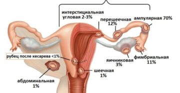 При внематочной беременности матка увеличивается