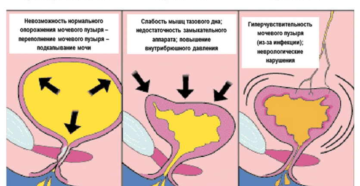Недержание мочи при кашле во время беременности