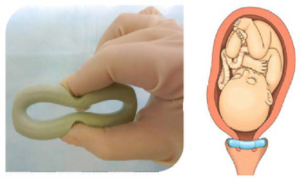 Для чего ставят кольцо на шейку матки при беременности